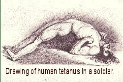 articles on tetanus